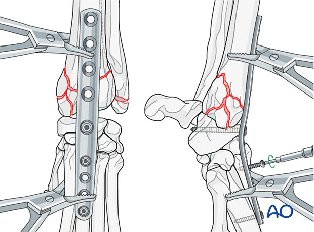 D23_P210_i180 Insertion of the third screw in the most proximal aspect of the third metacarpal bone
