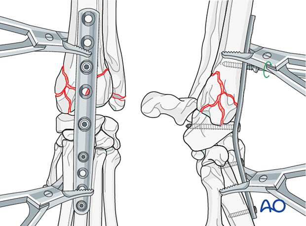 D23_P210_i200 Placing of the fourth screw in the distal radius, close to the fracture line