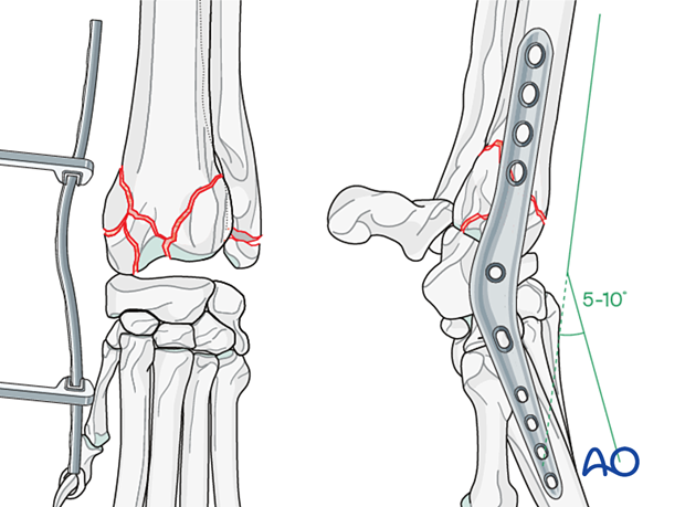 D23_P210_i240 Contouring of an appropriately sized plate to provide 5β10 degrees of extension of the radiocarpal joint