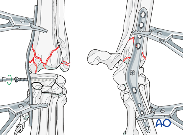 D23_P210_i280 Insertion of the first screw in the radial carpal bone
