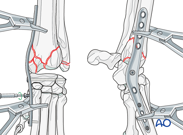 D23_P210_i320 Insertion of the third screw in the most proximal aspect of the metacarpal bone