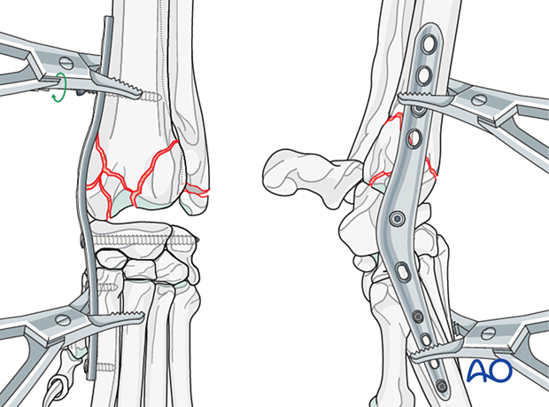 D23_P210_i340 Insertion of the fourth screw in the distal radius close to the fracture line