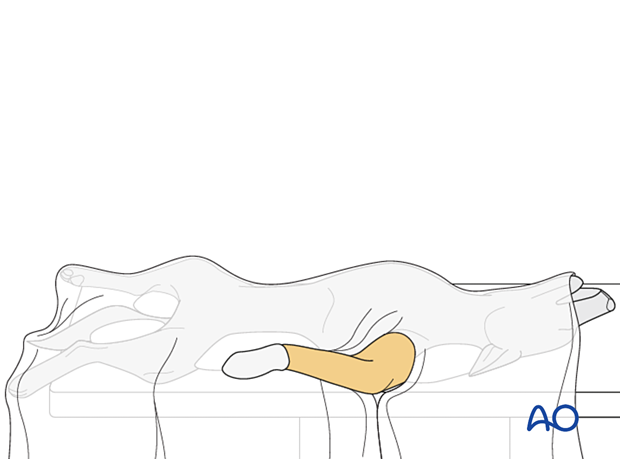 Corner drapes are placed around the surgical site and secured with towel clamps