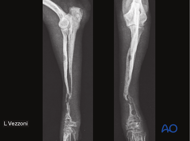 D23_X020_i020 Radioulnar atrophic nonunion in a 4-month-old Pomeranian dog after internal fixation