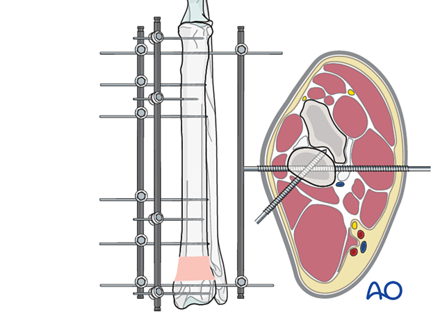 External skeletal fixator type III