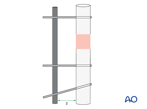 The stiffness of the frame depends upon factors like even distribution of the pins in each main fragment, distance from the connection bar from the bone, number of pins, etc