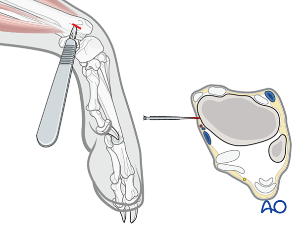 Pins should be placed through large releasing incisions made parallel to the long axis of the bone