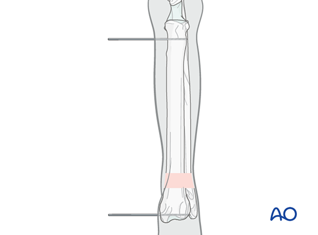 The pins adjacent to the joints are inserted first