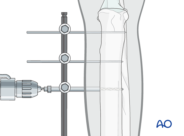 The remaining pins are placed by drilling the pilot hole with a drill guide placed through the clamp