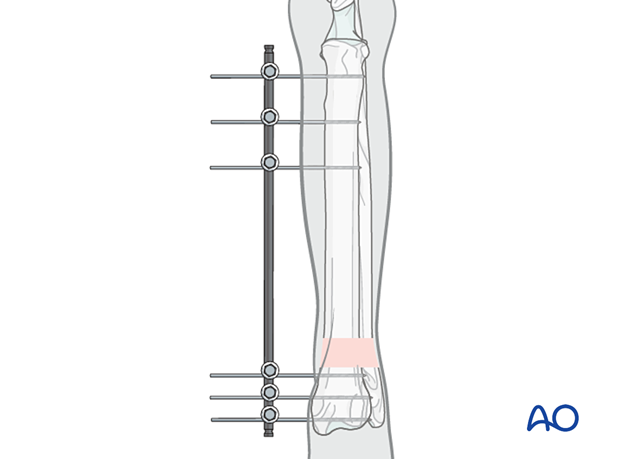 After the final hole is drilled, the drill guide is removed and the pins are placed through the clamps on the connecting bars
