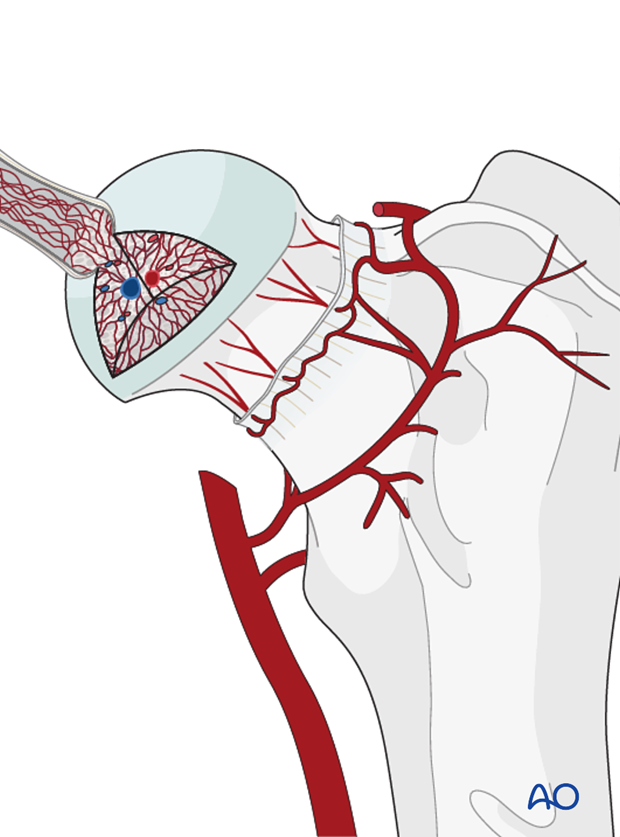craniolateral approach combined with a dorsal approach