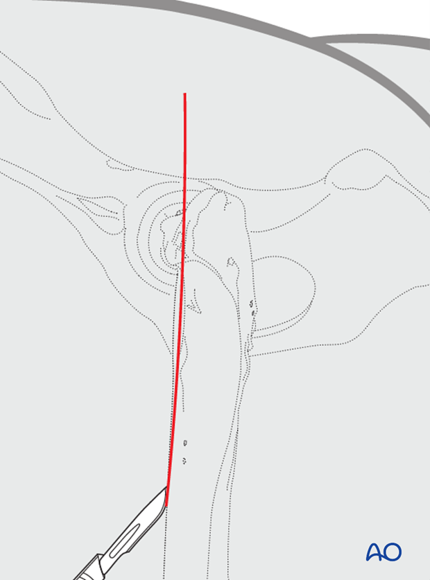 lag screw and k wire