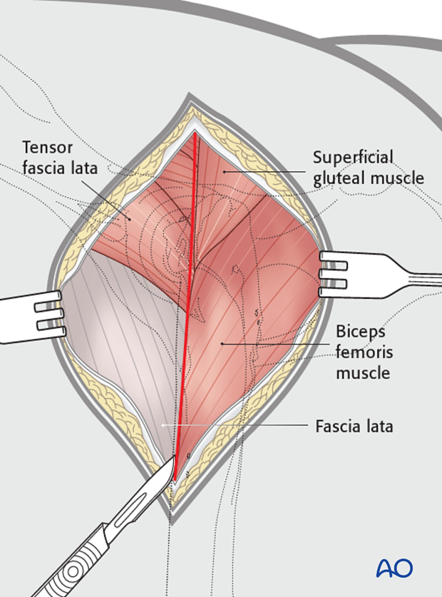 craniolateral approach combined with a dorsal approach