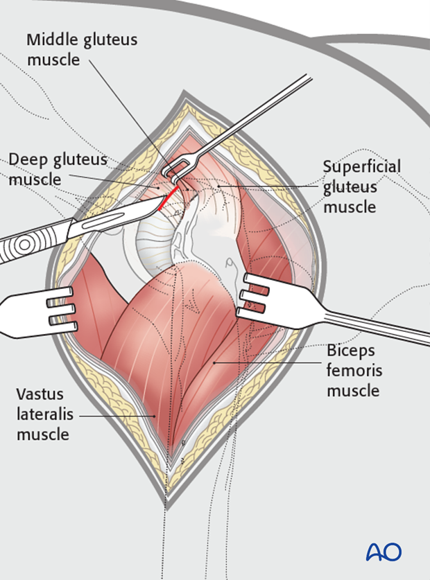 craniolateral approach combined with a dorsal approach
