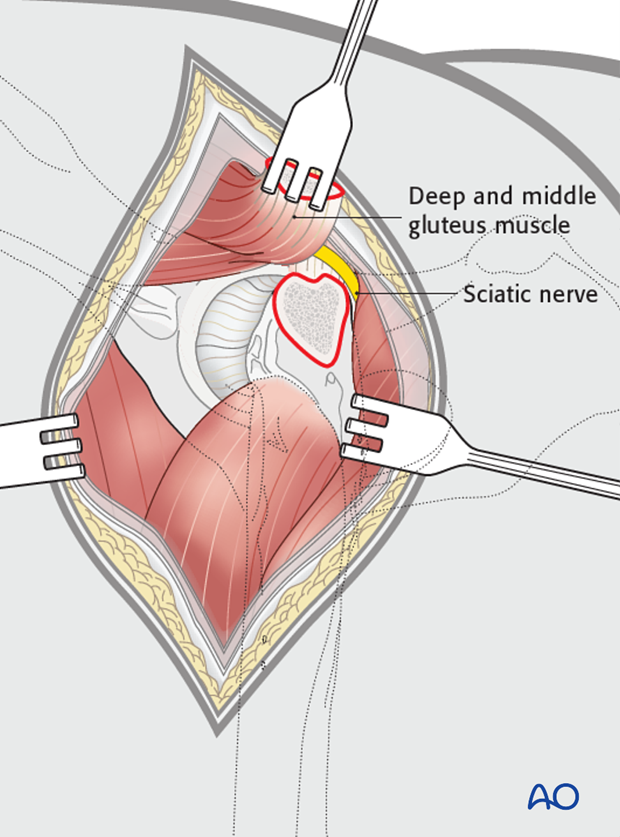 craniolateral approach combined with a dorsal approach