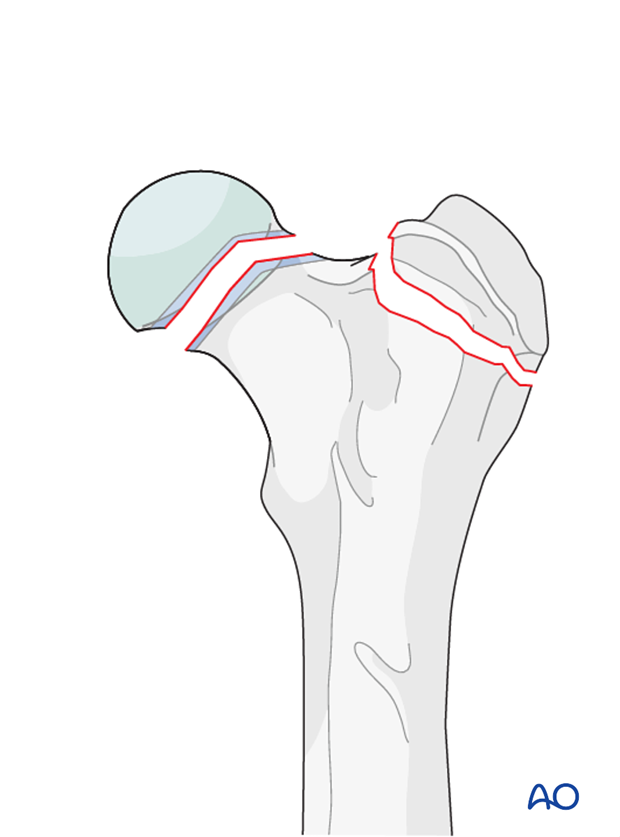 D31_D00_i160 definition