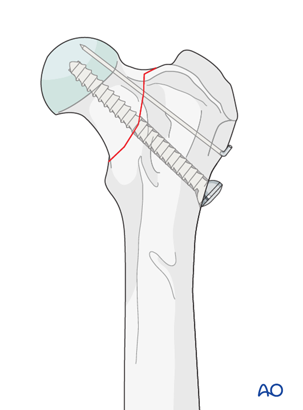 lag screw and k wire