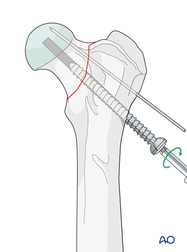 lag screw and k wire