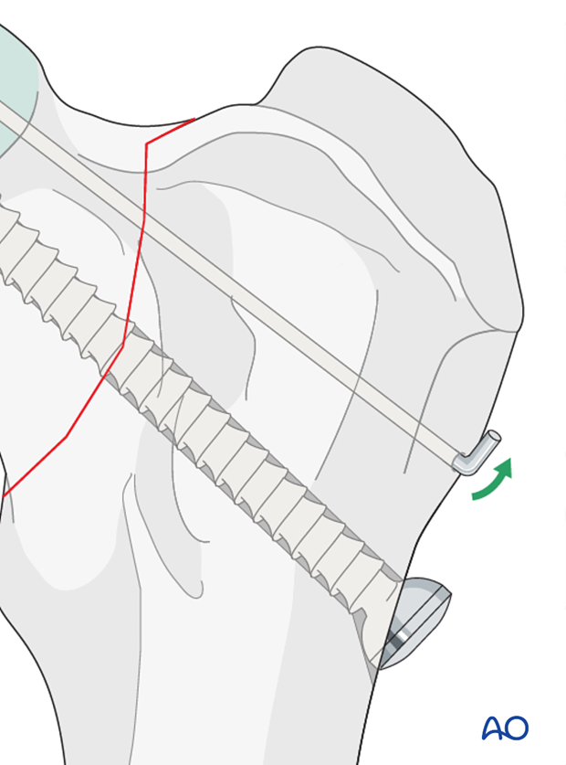 lag screw and k wire