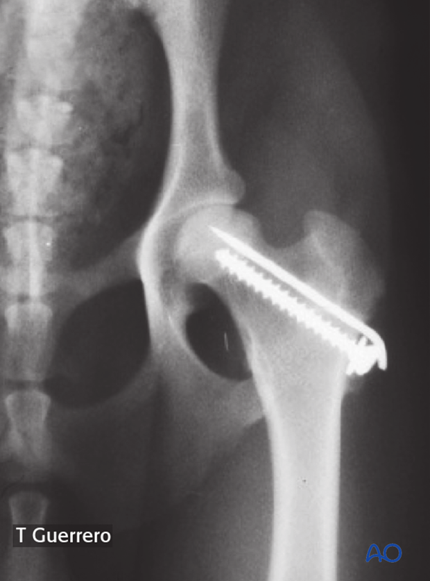 lag screw and k wire