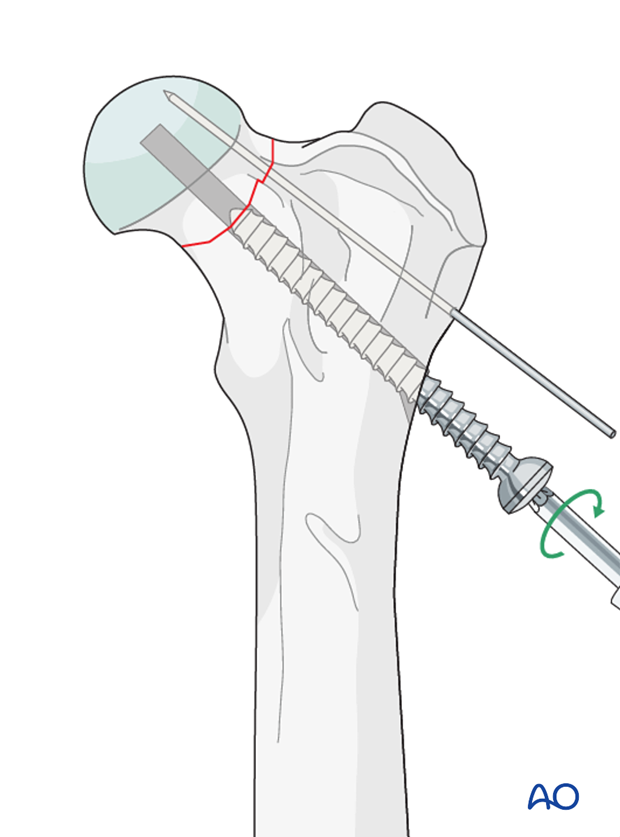 lag screw and k wire