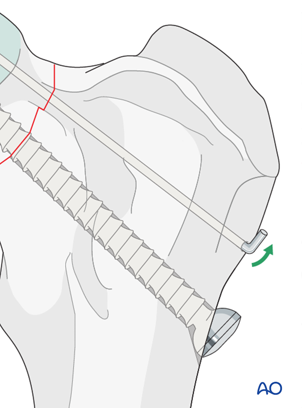 lag screw and k wire