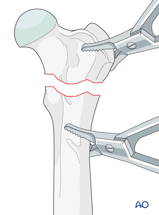 plate fixation