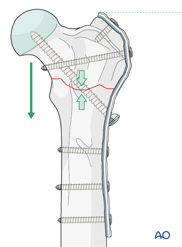 plate fixation