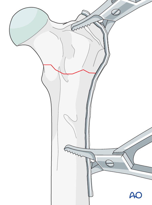 plate fixation