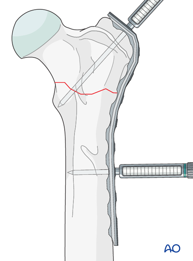 plate fixation