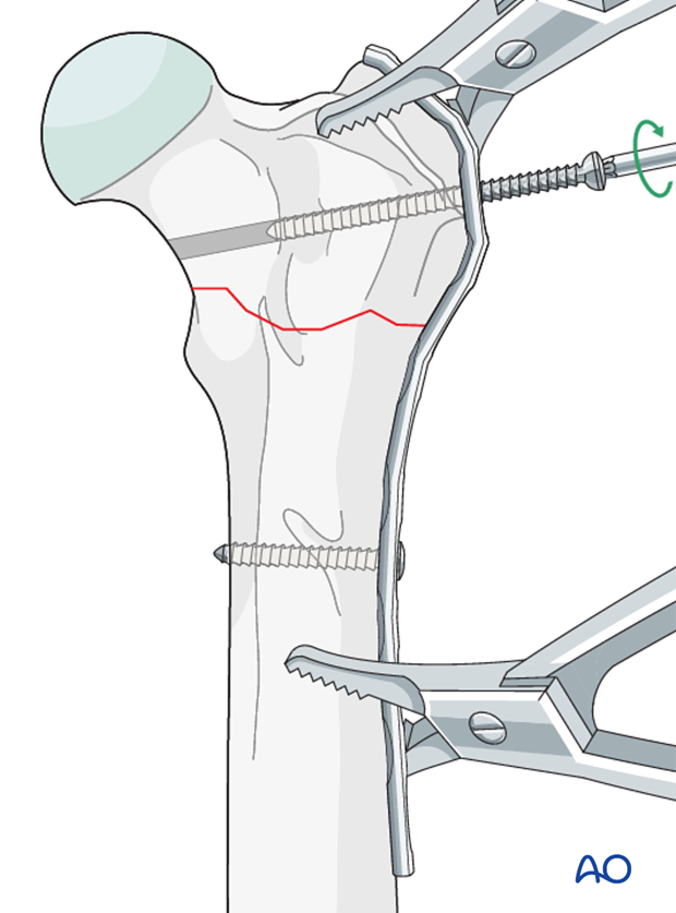 plate fixation