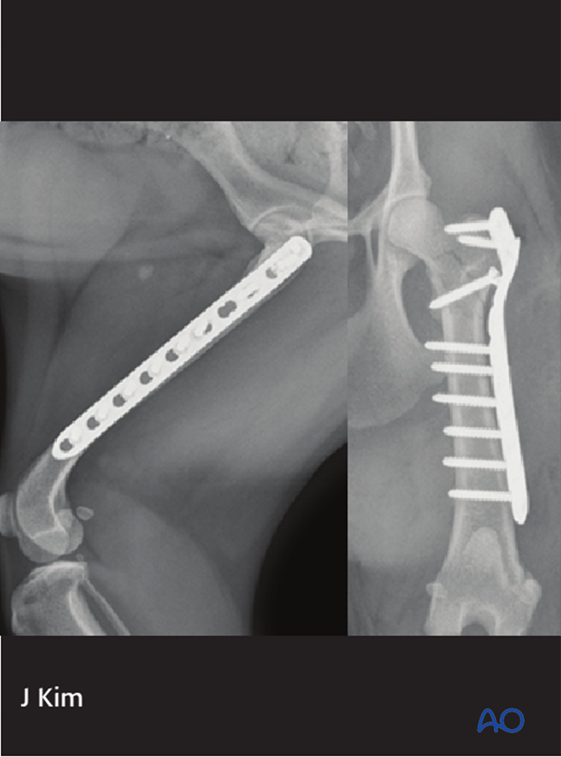 plate fixation