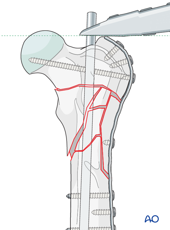 Plate and rod for Trochanteric region, multifragmentary