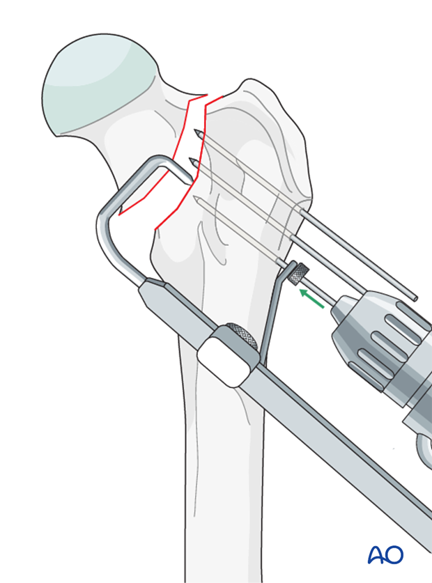 parallel k wires