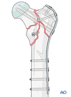 plate and lag screw fixation