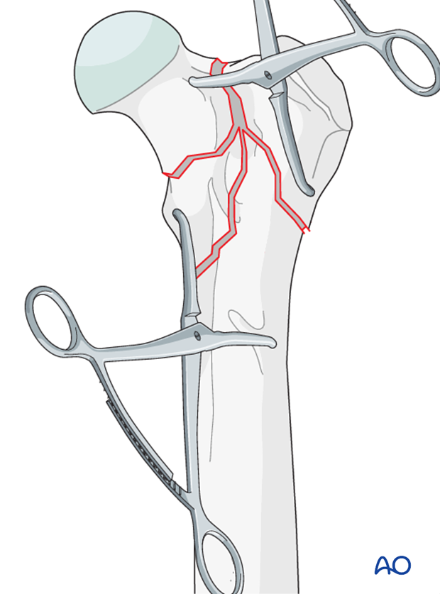 plate and lag screw fixation