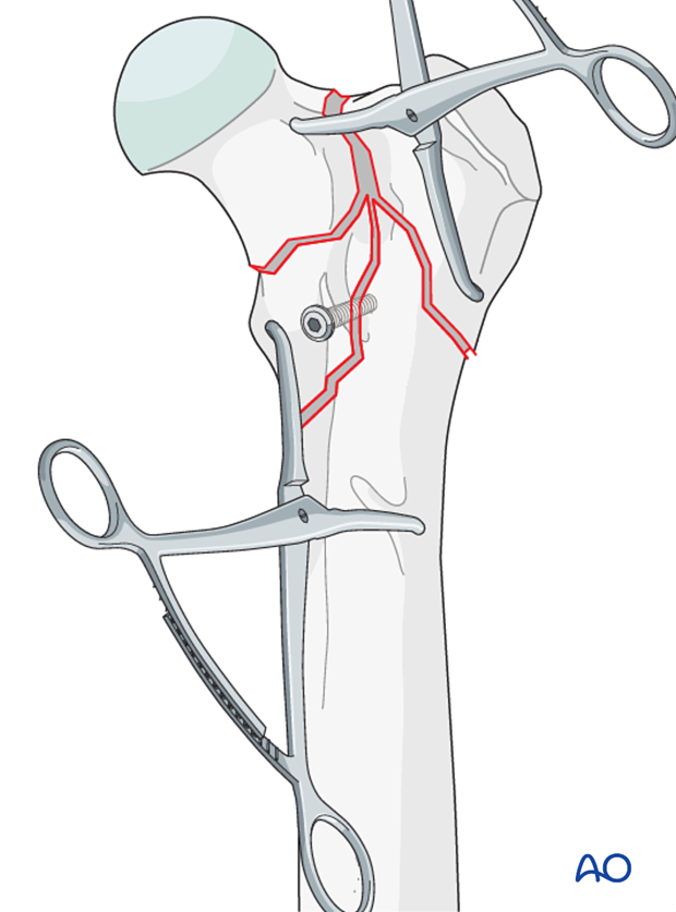 plate and lag screw fixation