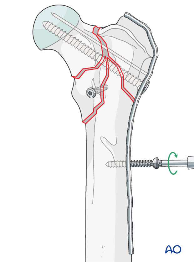 plate and lag screw fixation