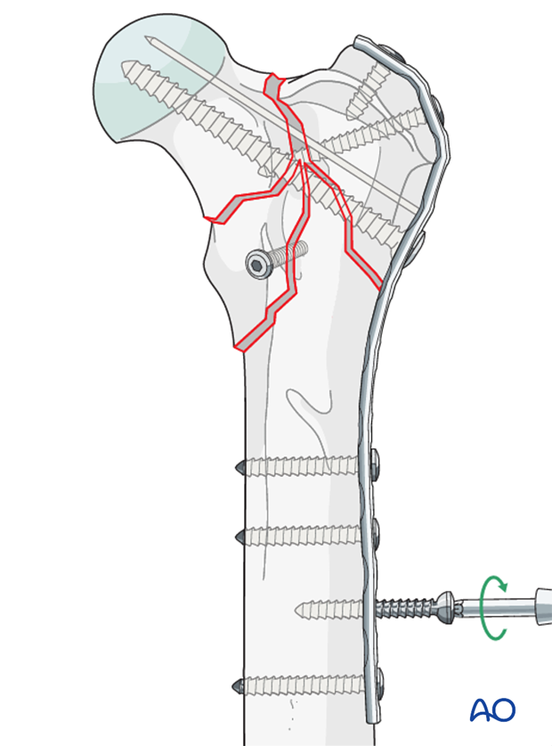 plate and lag screw fixation