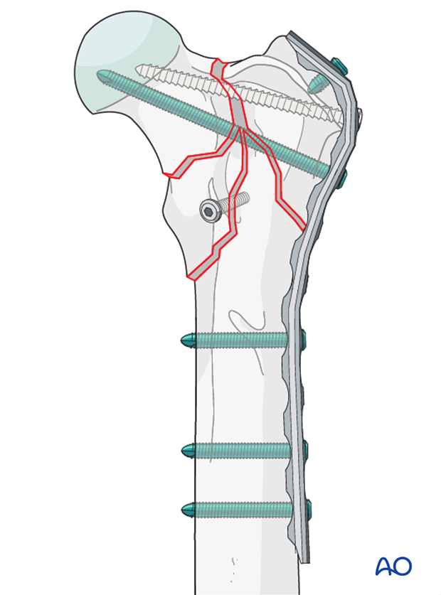 plate and lag screw fixation