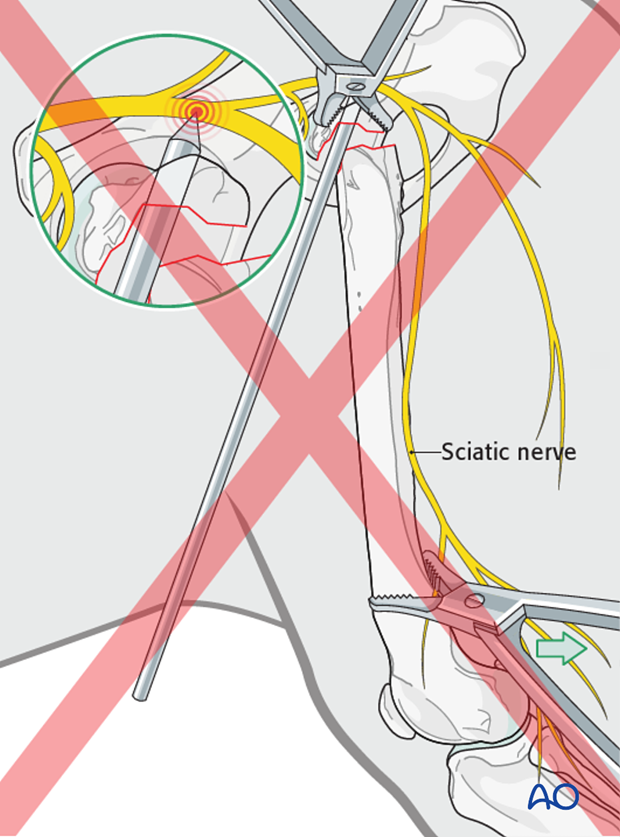 prognosis and complications with proximal femoral fractures