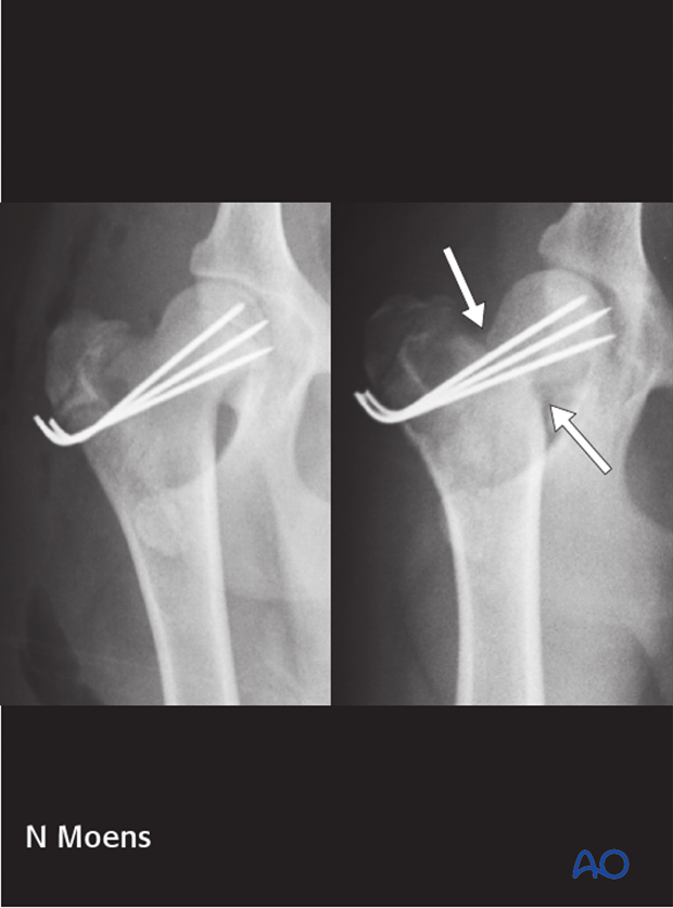 prognosis and complications with proximal femoral fractures