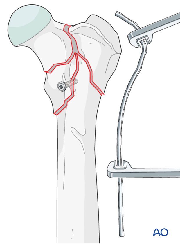 D31_X20_i160 plate preparation