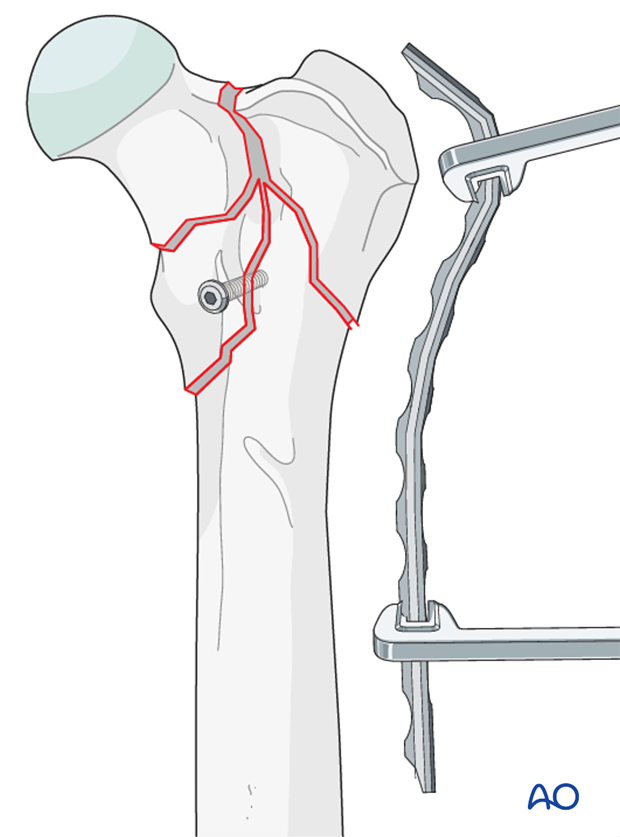 D31_X20_i180 plate preparation