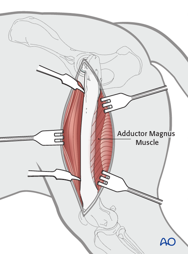 open approach to the femoral shaft