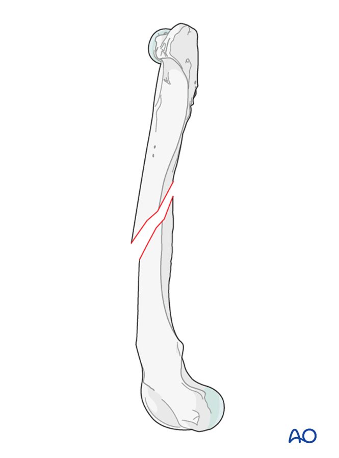 Simple oblique fractures of the femoral diaphysis
