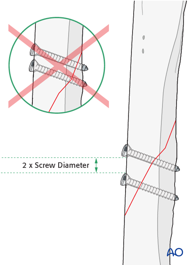 Lag screw fixation