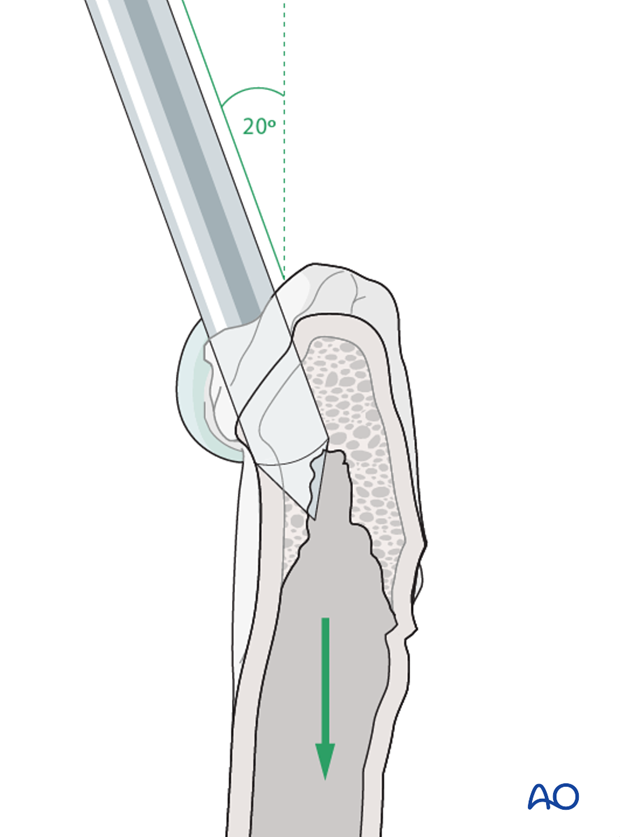 intramedullary pin fixation with cerclage wires