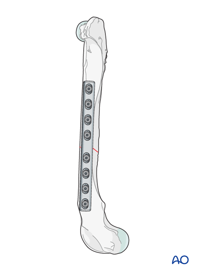 Compression plate for Simple transverse fractures of the femoral diaphysis