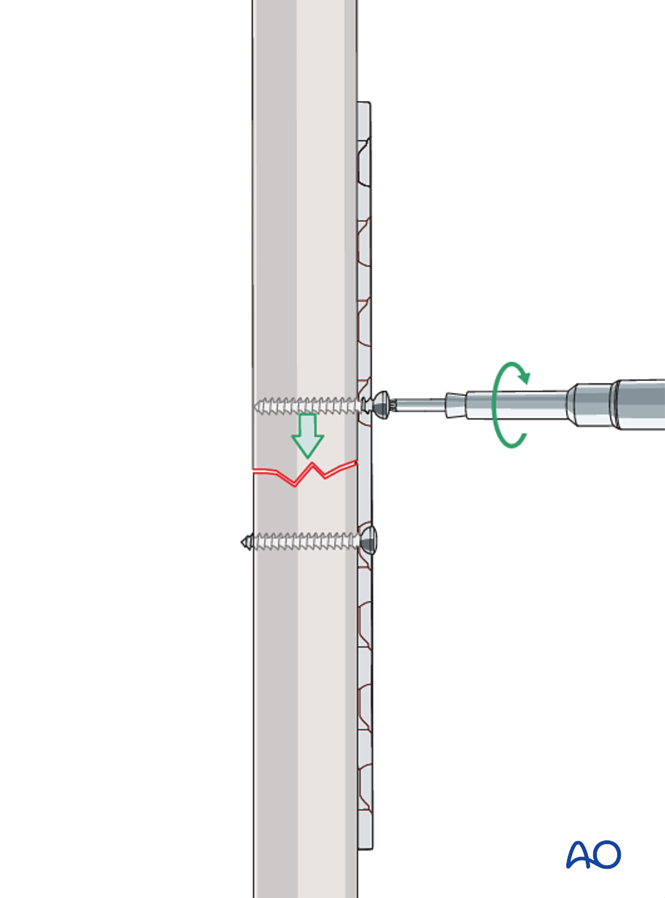 Compression plate for Simple transverse fractures of the femoral diaphysis